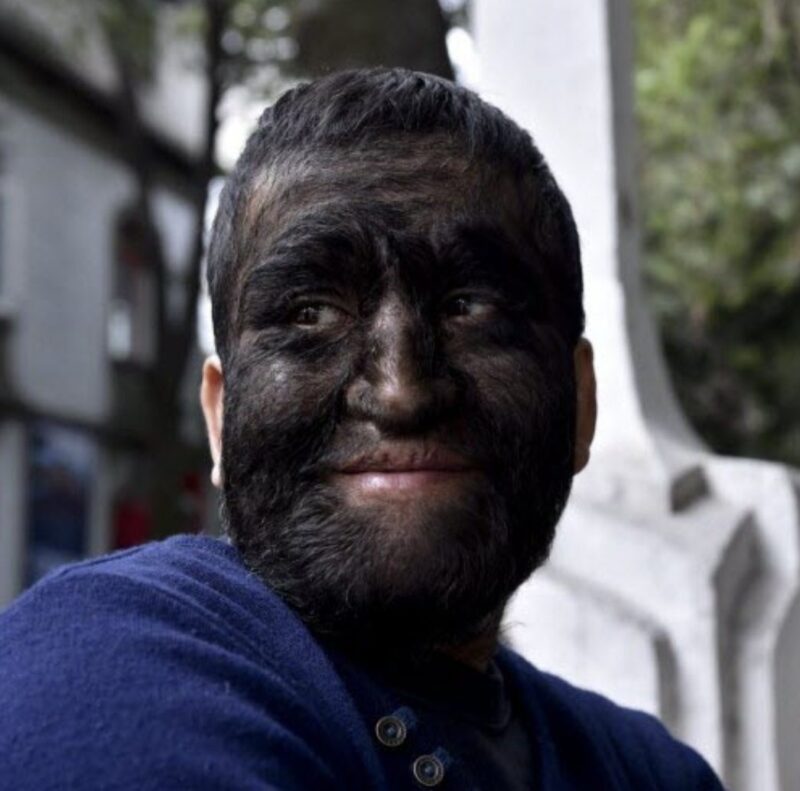 L’homme-loup s'est retiré du regard des autres en raison de son apparence: les photos ci-dessous