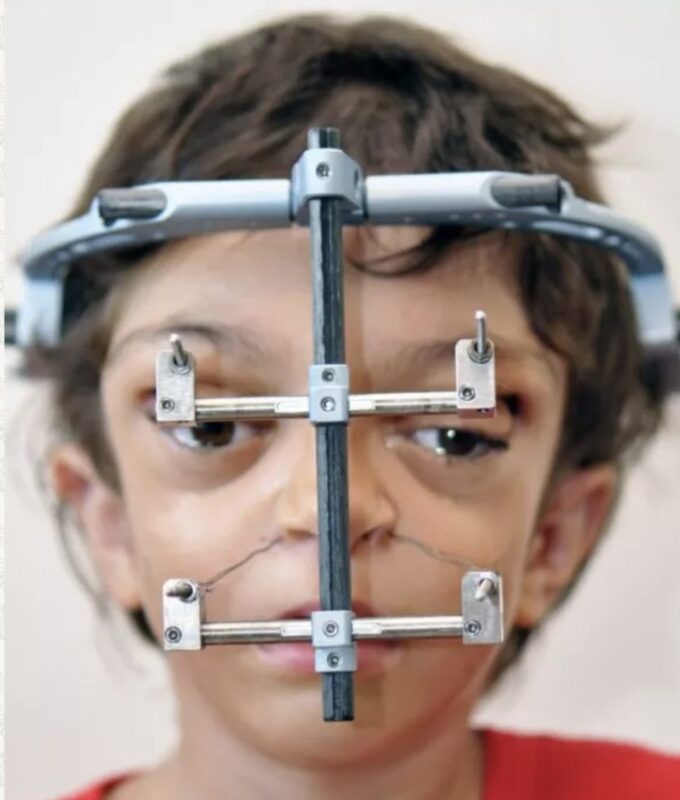 Les médecins ont réussi à transformer le visage de ce garçon: Découvrez son apparence actuelle